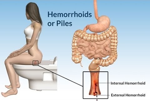 Haemorrhoids / Piles