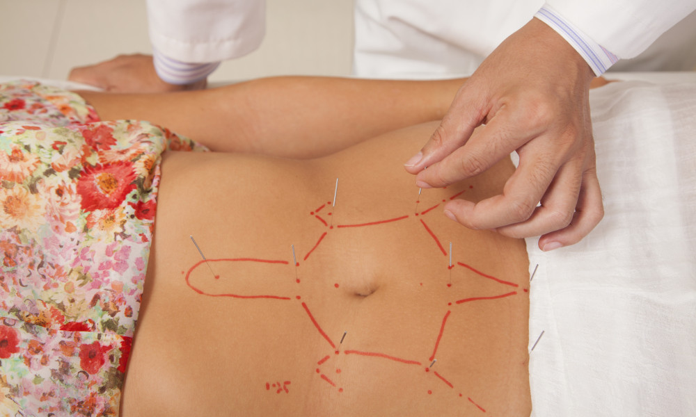 Acupuncture for IBS