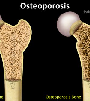 Osteoporosis – Signs and Symptoms