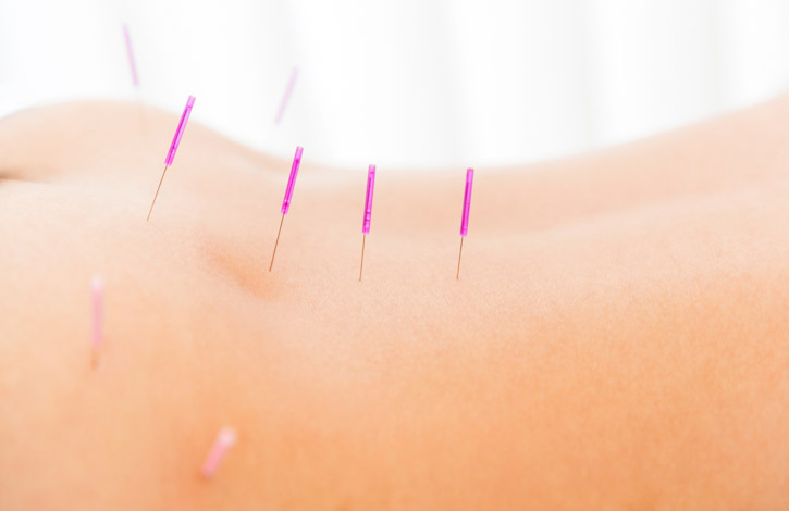 Acupuncture for Back Pain and Sciatica