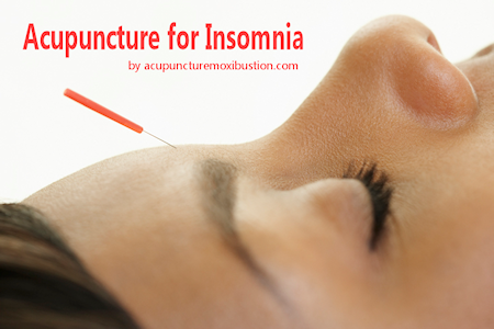 Acupuncture for Sleep
