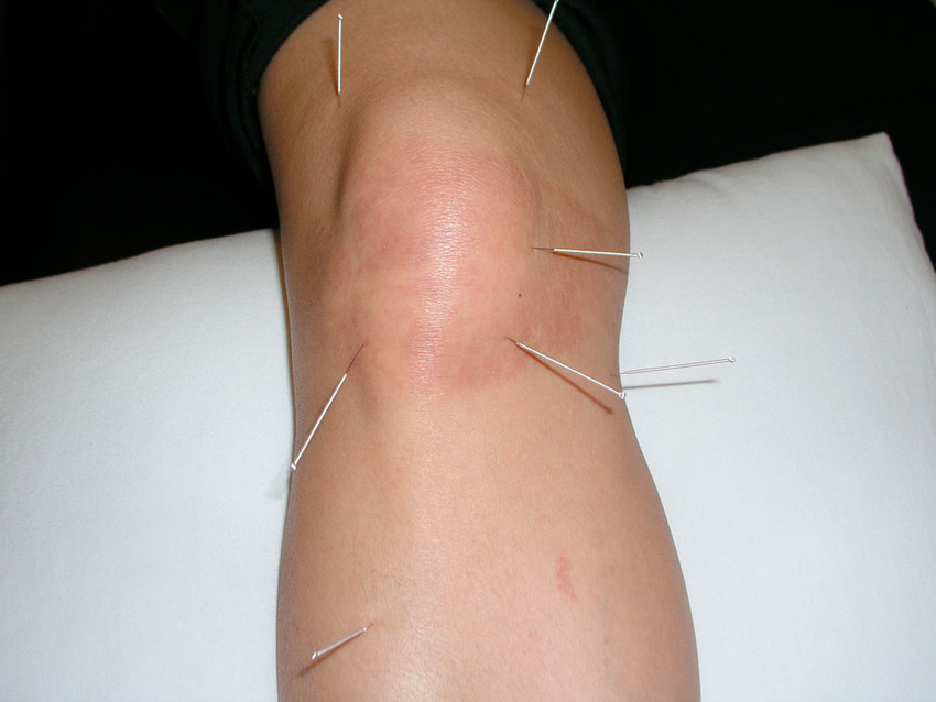 Acupuncture and Knee Pain